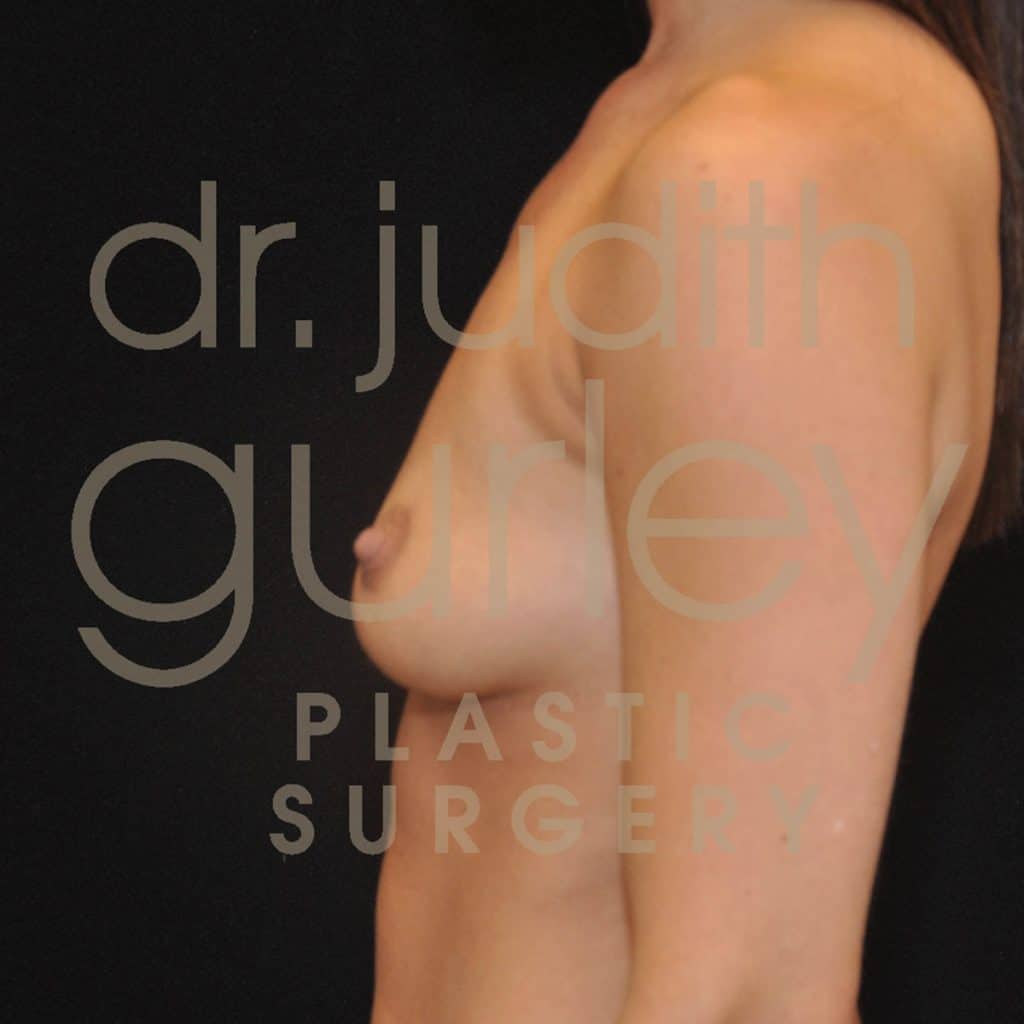 Breast Augmentation Before & After Patient #5293