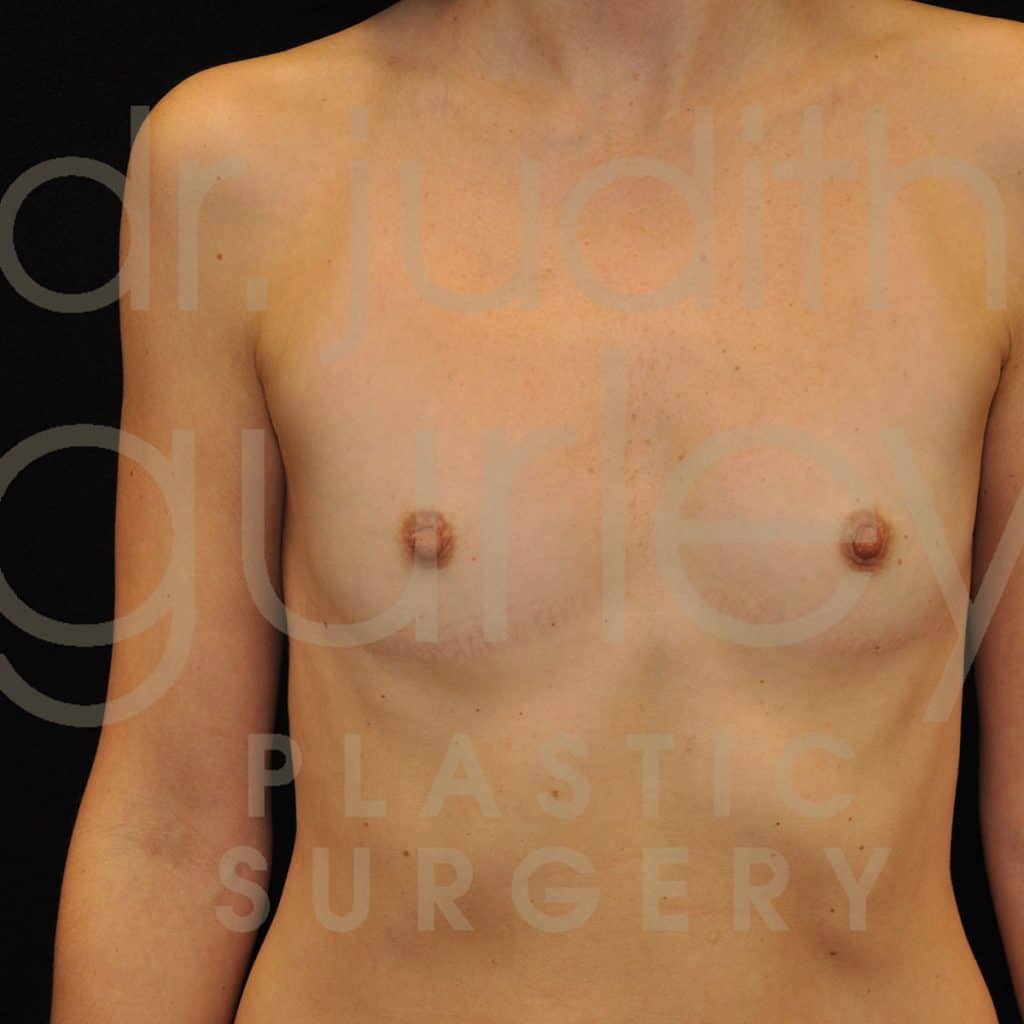 Breast Augmentation Before & After Patient #8231