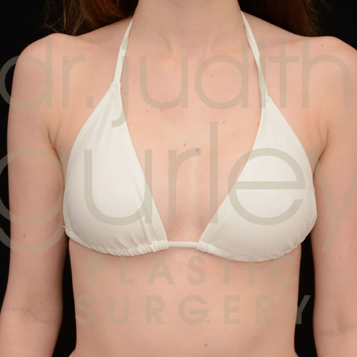 Breast Augmentation Before & After Patient #1231