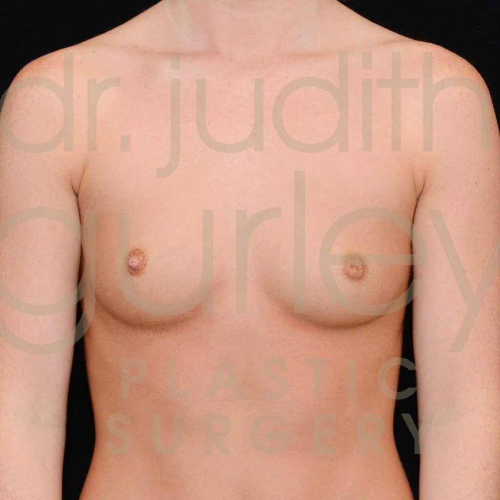 Breast Augmentation Before & After Patient #1277