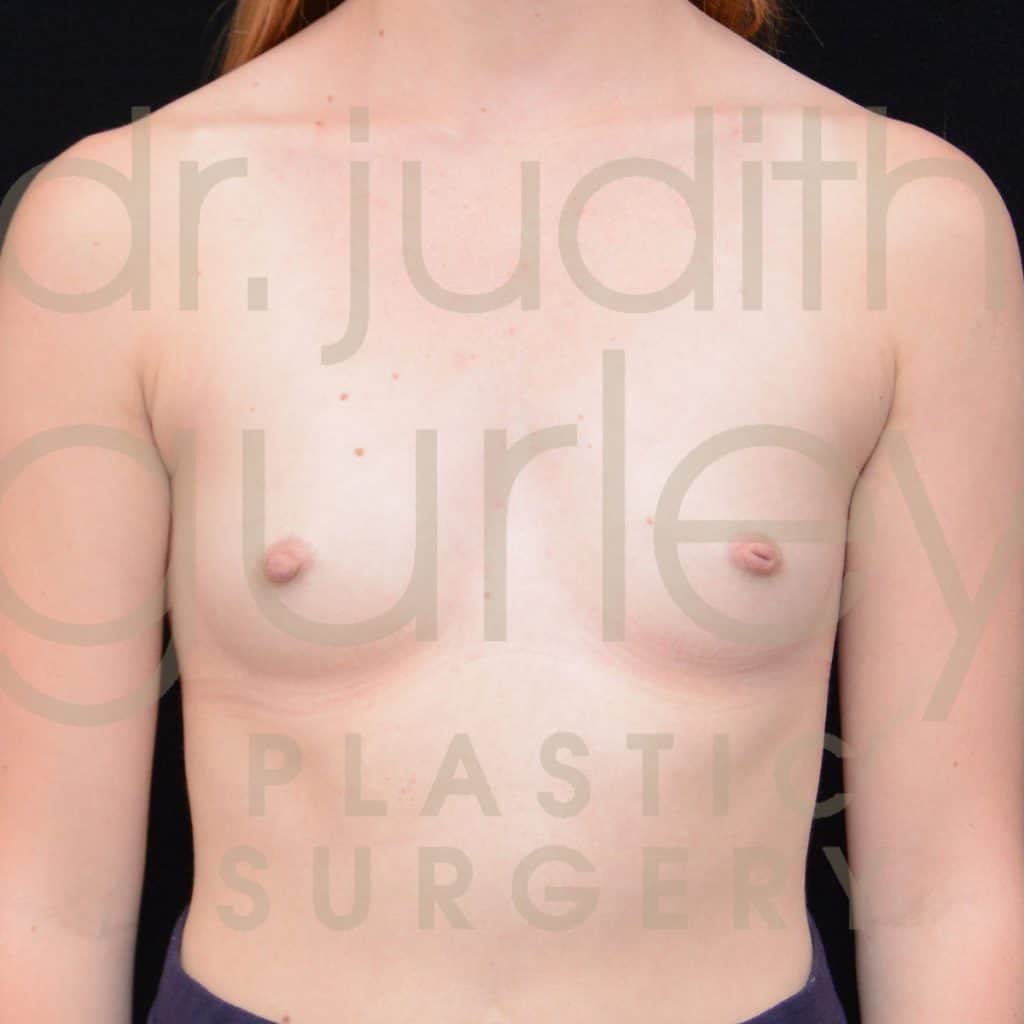 Breast Augmentation Before & After Patient #1737