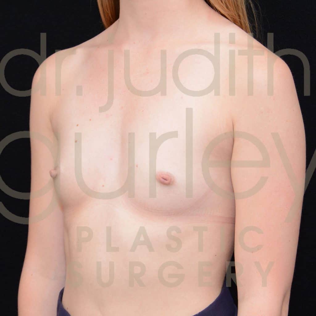 Breast Augmentation Before & After Patient #1737