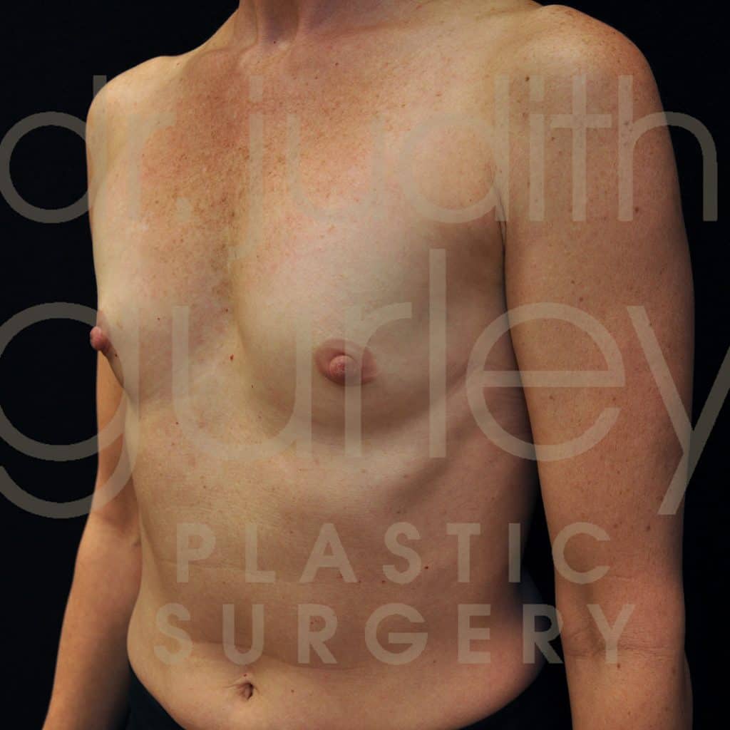 Breast Augmentation Before & After Patient #7065