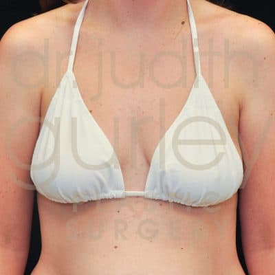 Breast Augmentation and Lift Before & After Patient #2229