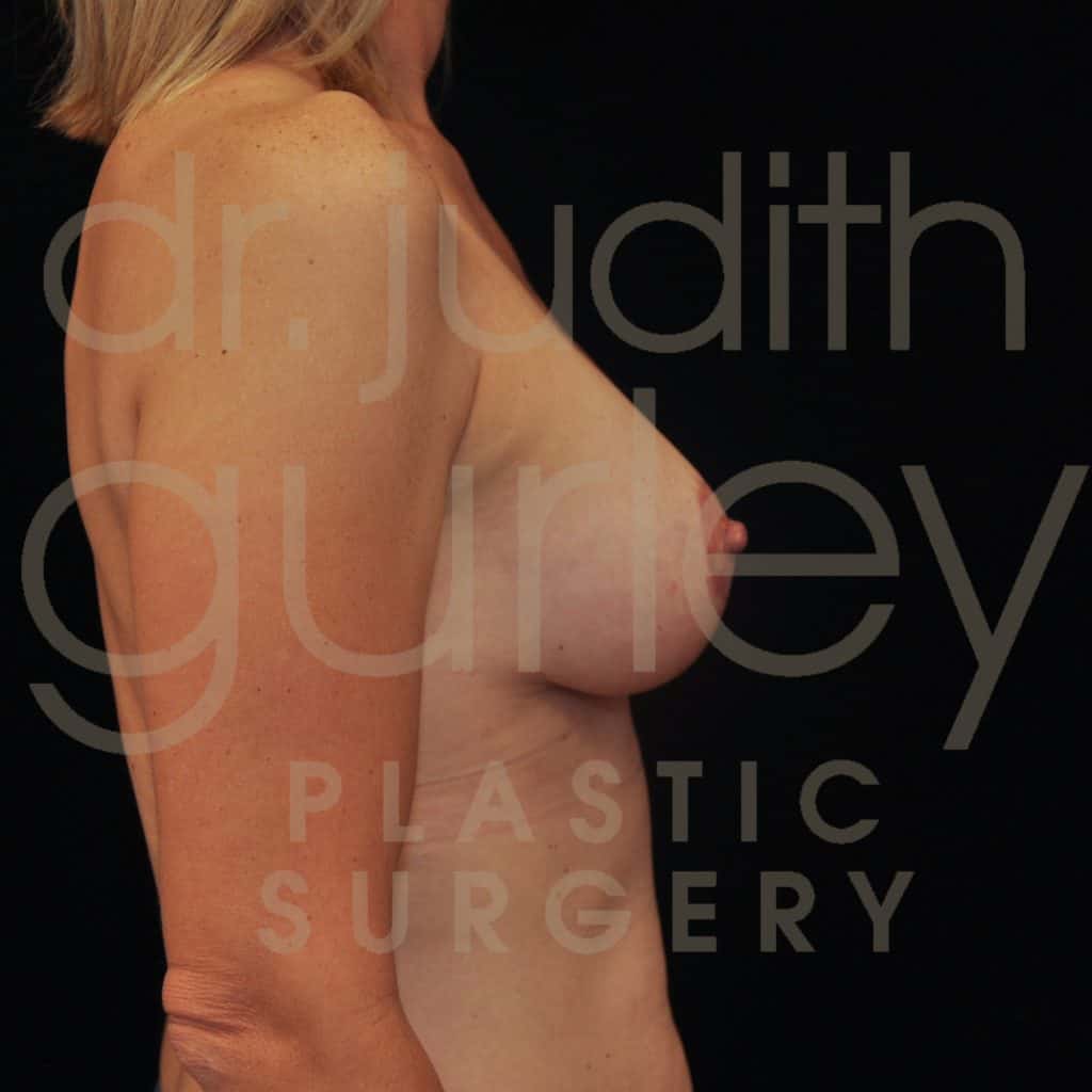 Breast Augmentation and Lift Before & After Patient #2276