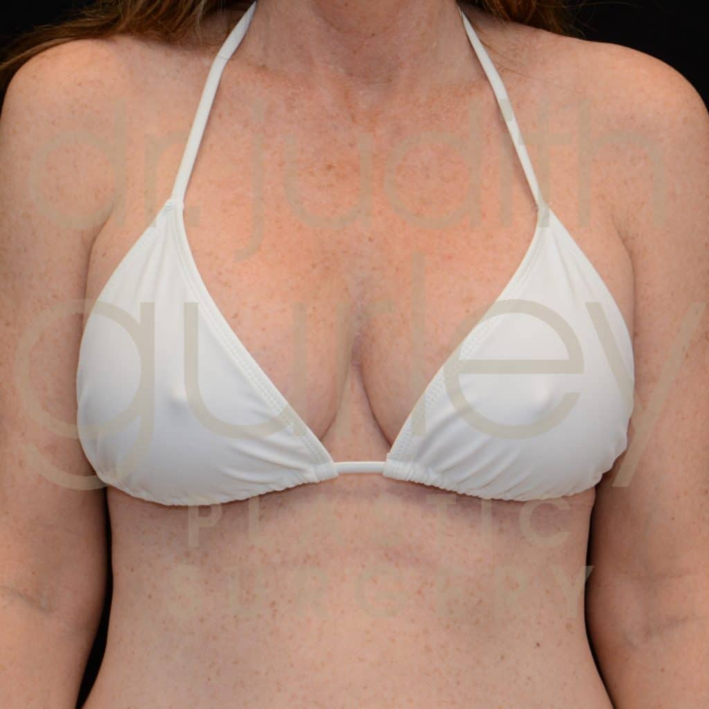 Breast Augmentation and Lift Before & After Results