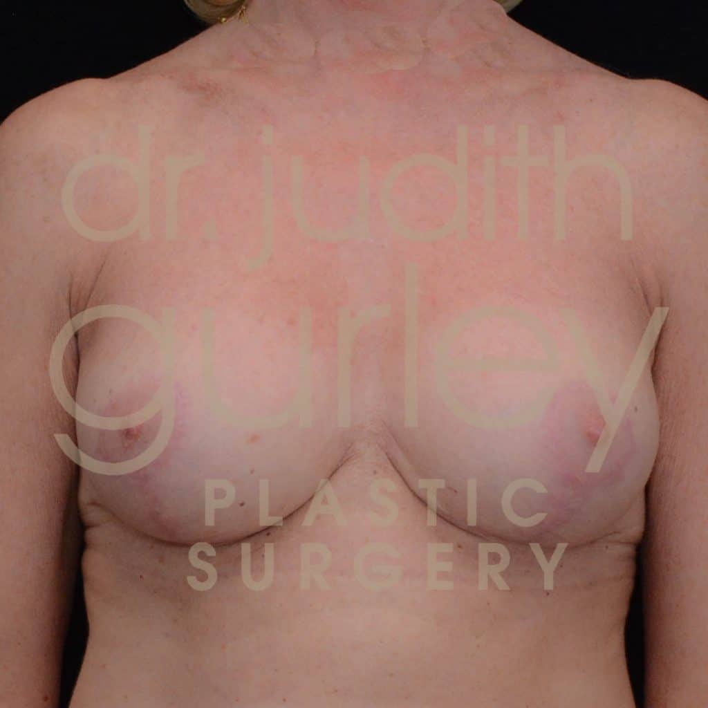 Breast Augmentation and Lift Before & After Patient #3028