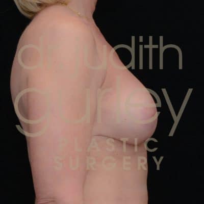 Breast Augmentation and Lift Before & After Patient #3028
