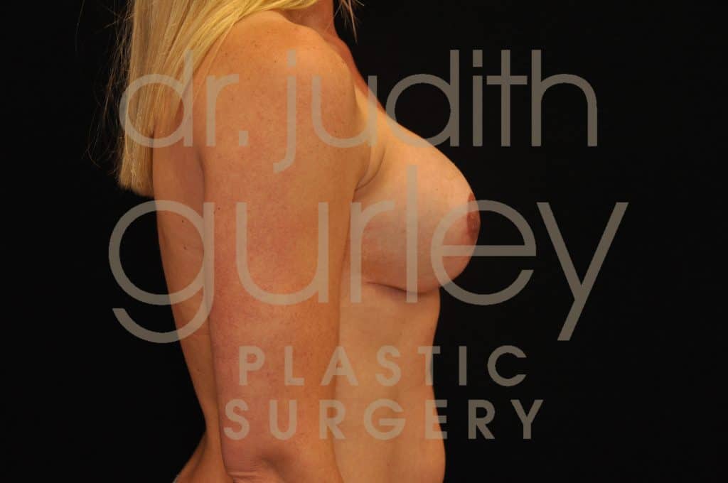 Breast Surgery Before & After Results