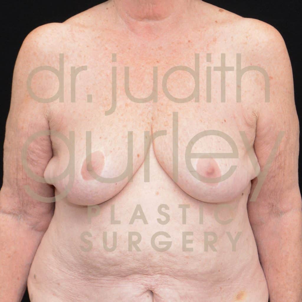 Breast Augmentation and Lift Before & After Patient #3310
