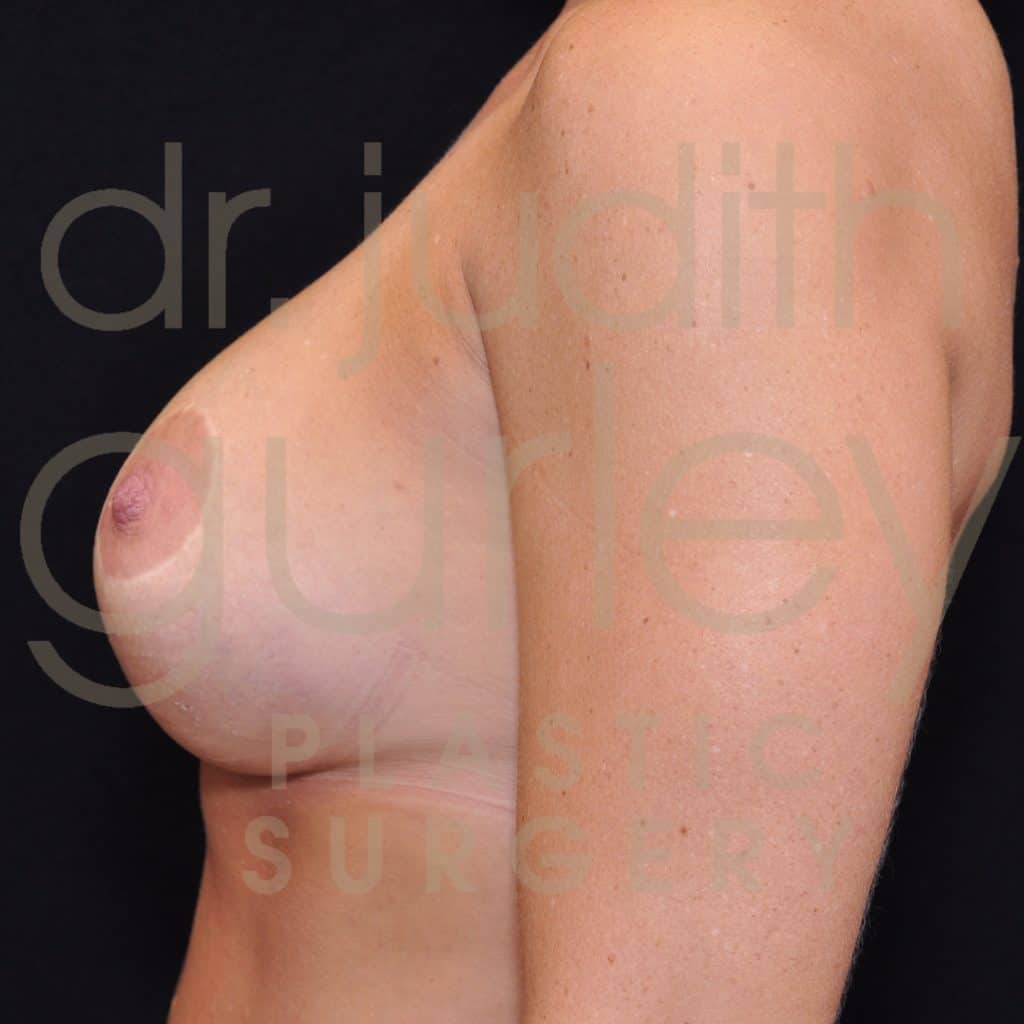 Breast Augmentation and Lift Before & After Patient #1242