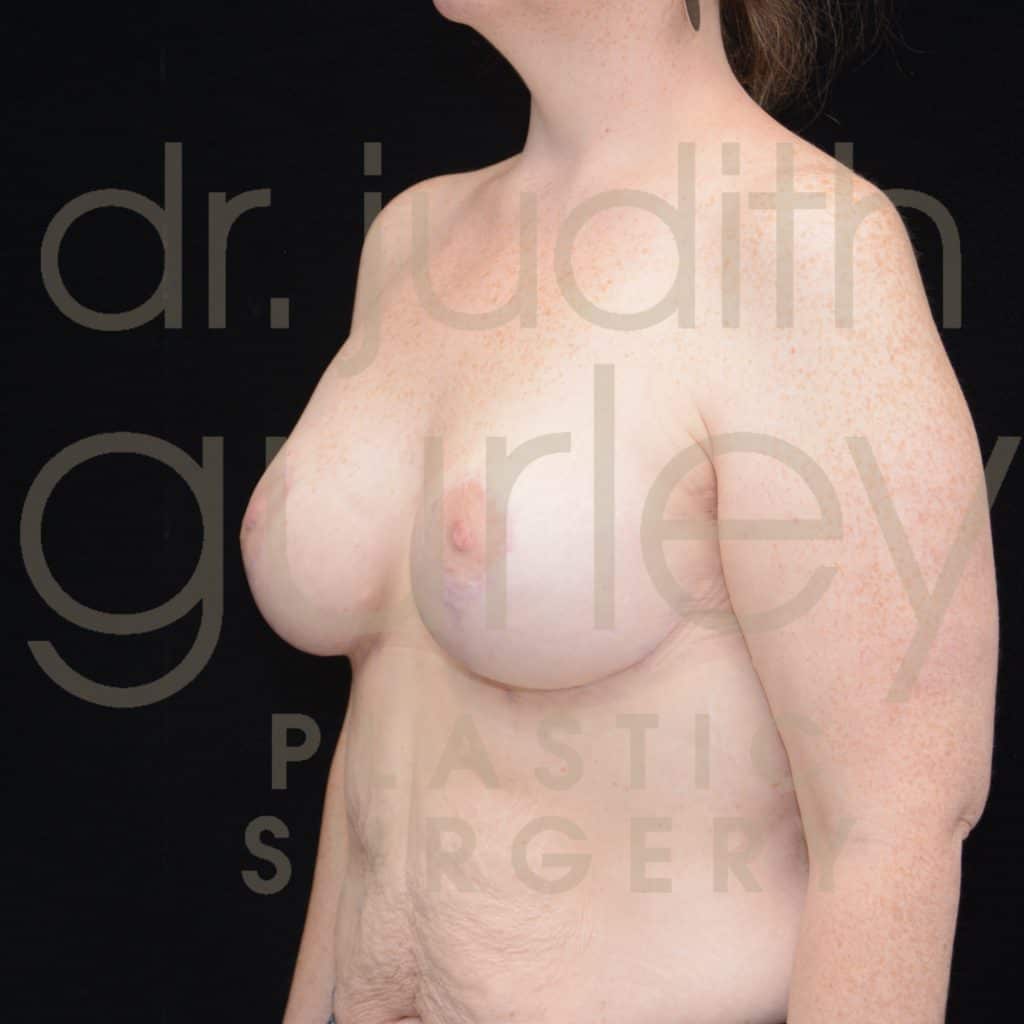 Breast Augmentation and Lift Before & After Patient #1336
