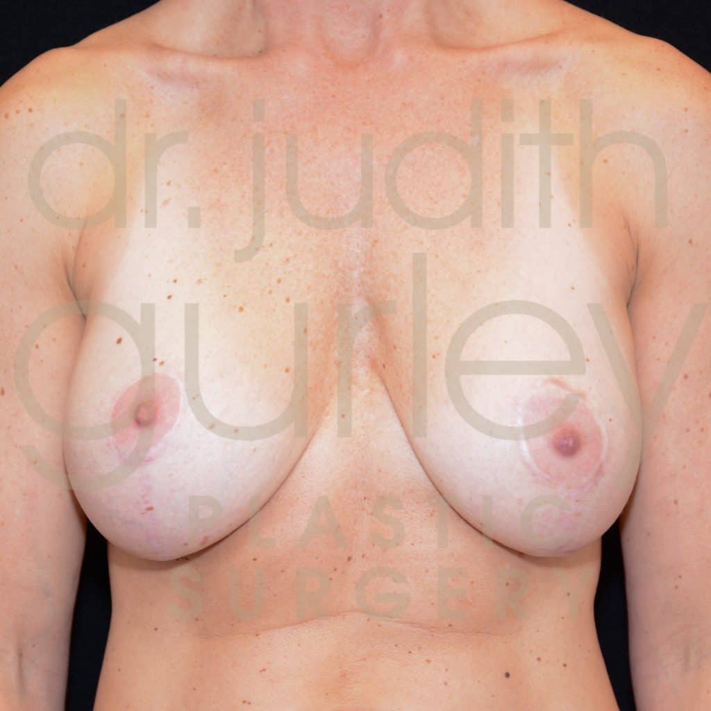 Breast Augmentation and Lift Before & After Patient #1524