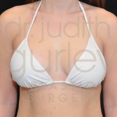 Breast Augmentation and Lift Before & After Patient #1571