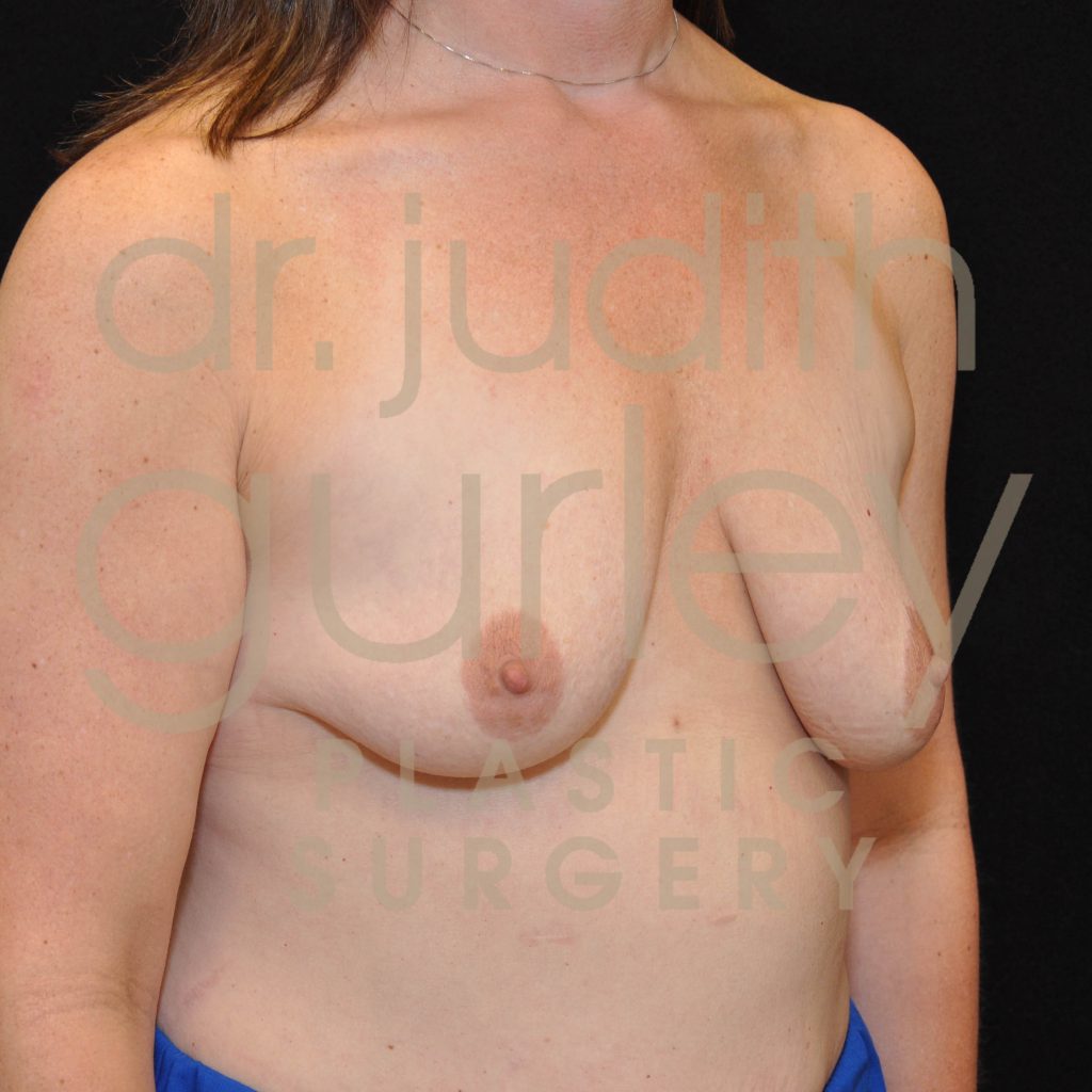 Breast Asymmetry Correction Surgery Before & After Patient # 3118