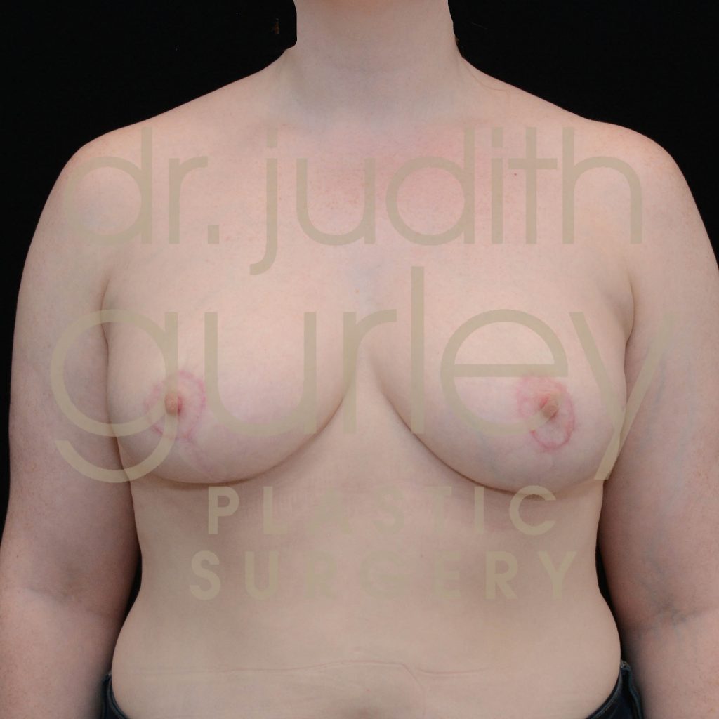 Breast Asymmetry Correction Surgery Before & After Results
