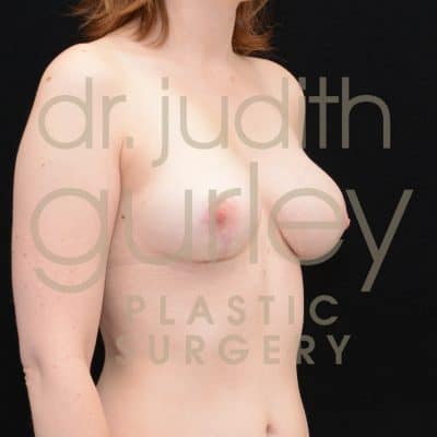 Breast Reduction Surgery Before & After Patient # 5118