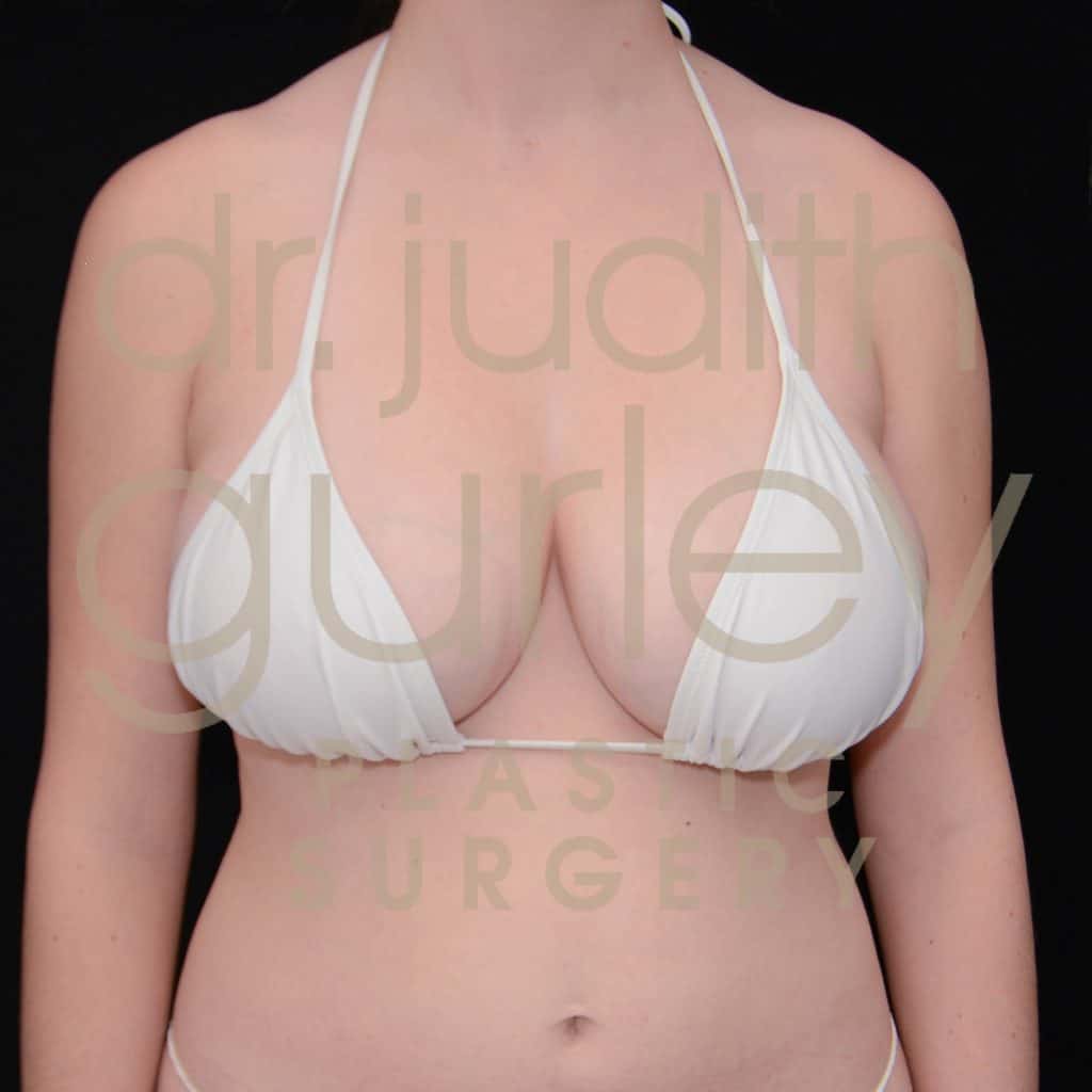 Breast Reduction Surgery Before & After Patient # 5682