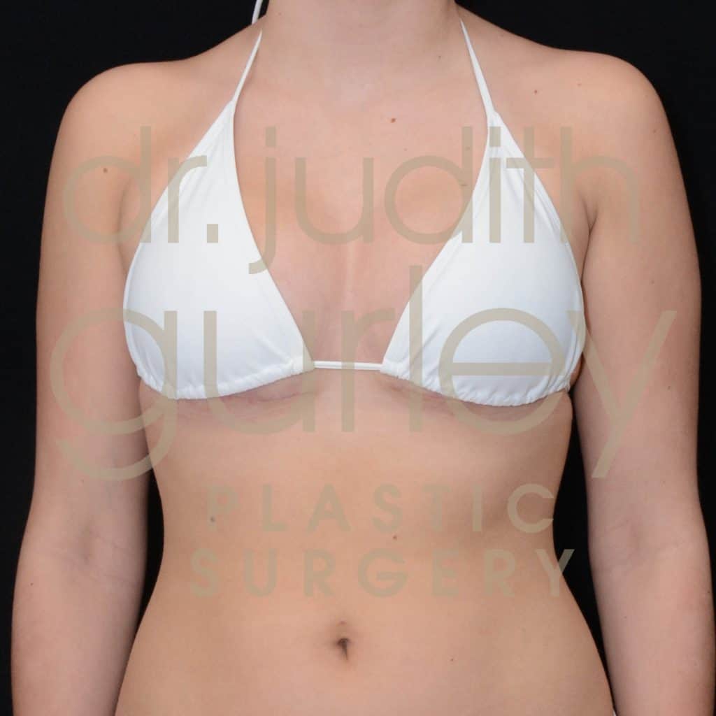 Breast Reduction Surgery Before & After Patient # 5917
