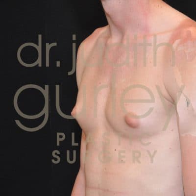 Gynecomastia Correction Surgery Before and After Results