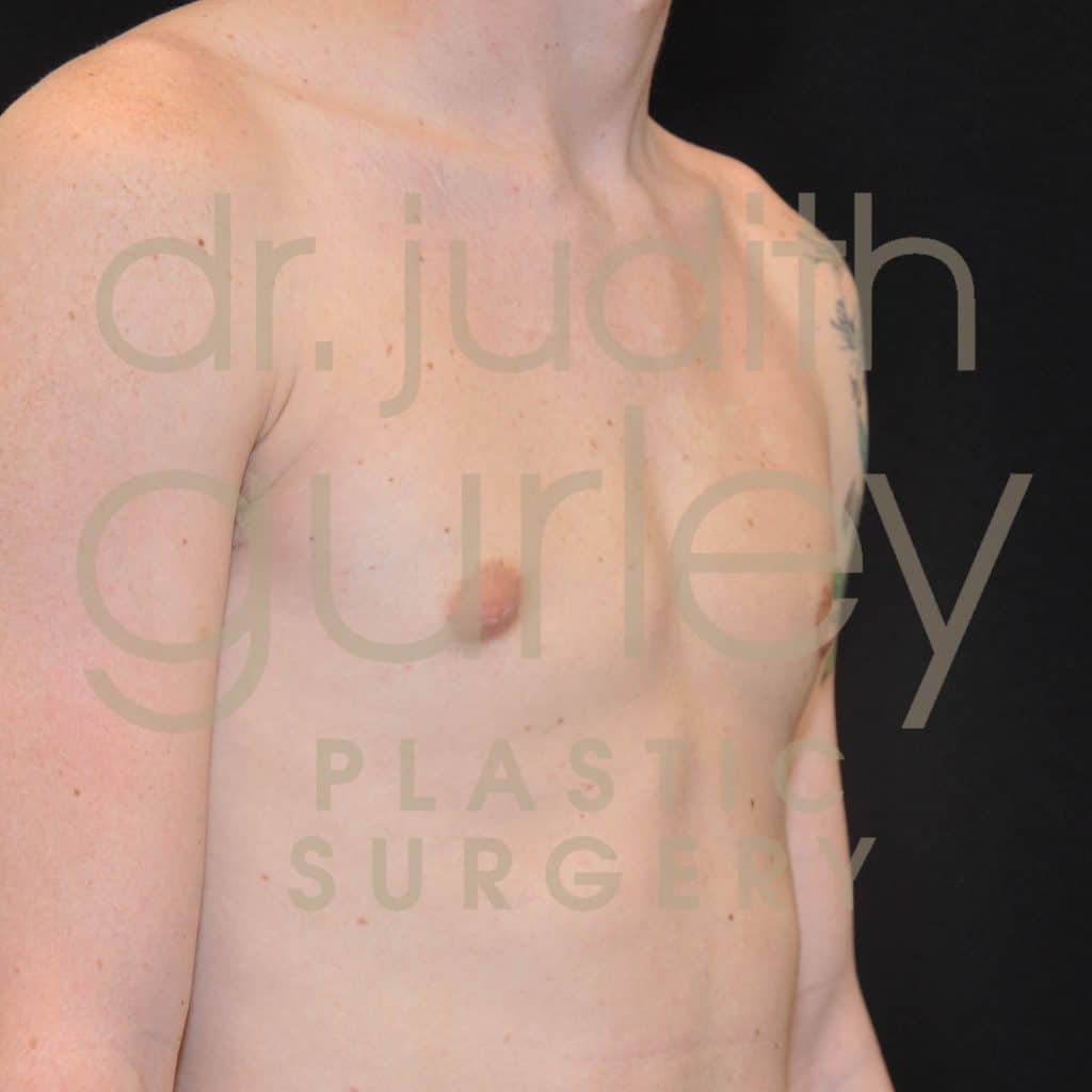 Gynecomastia Correction Surgery Before and After Results