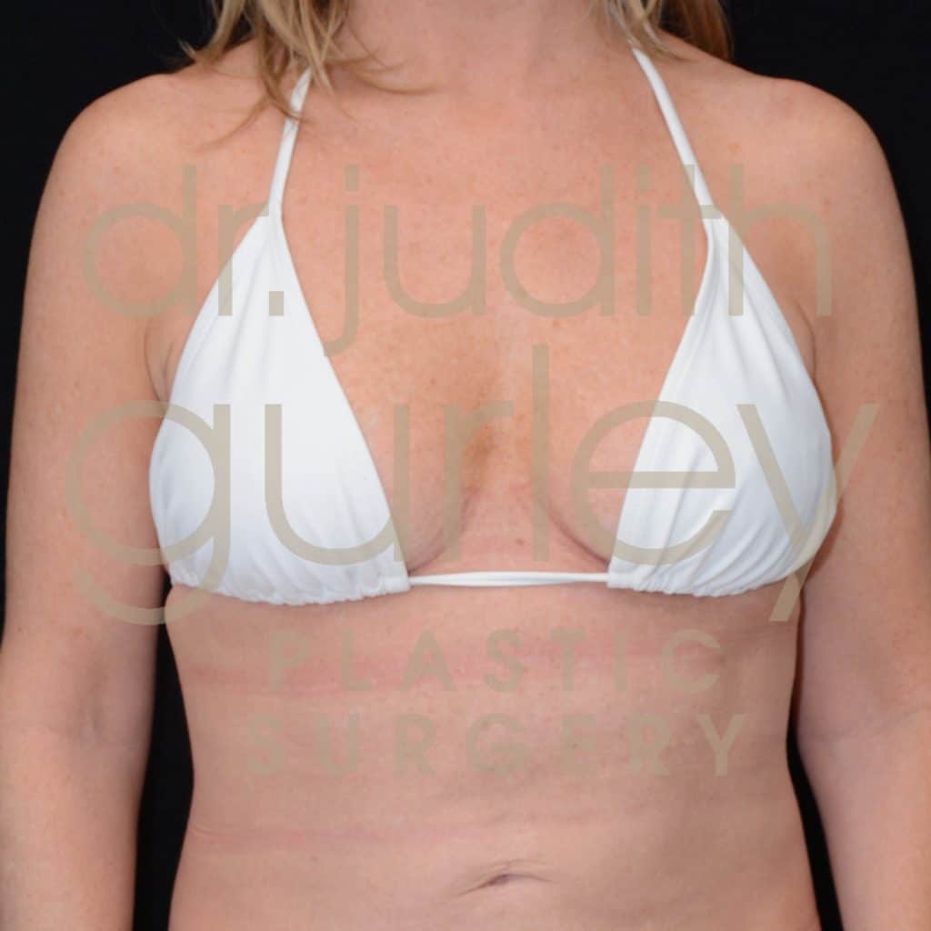 Breast Lift Before & After Patient #2529