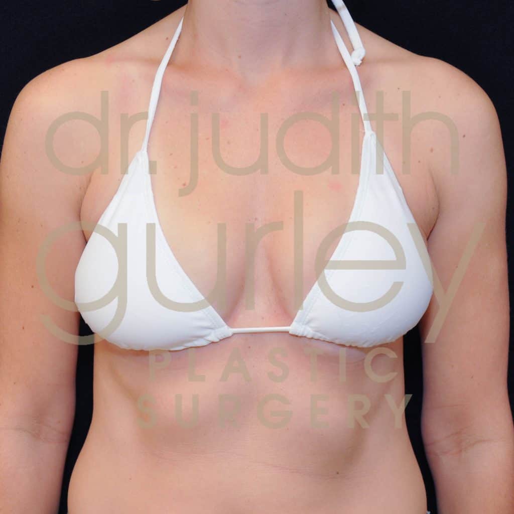 Breast Lift Before & After Patient #2717