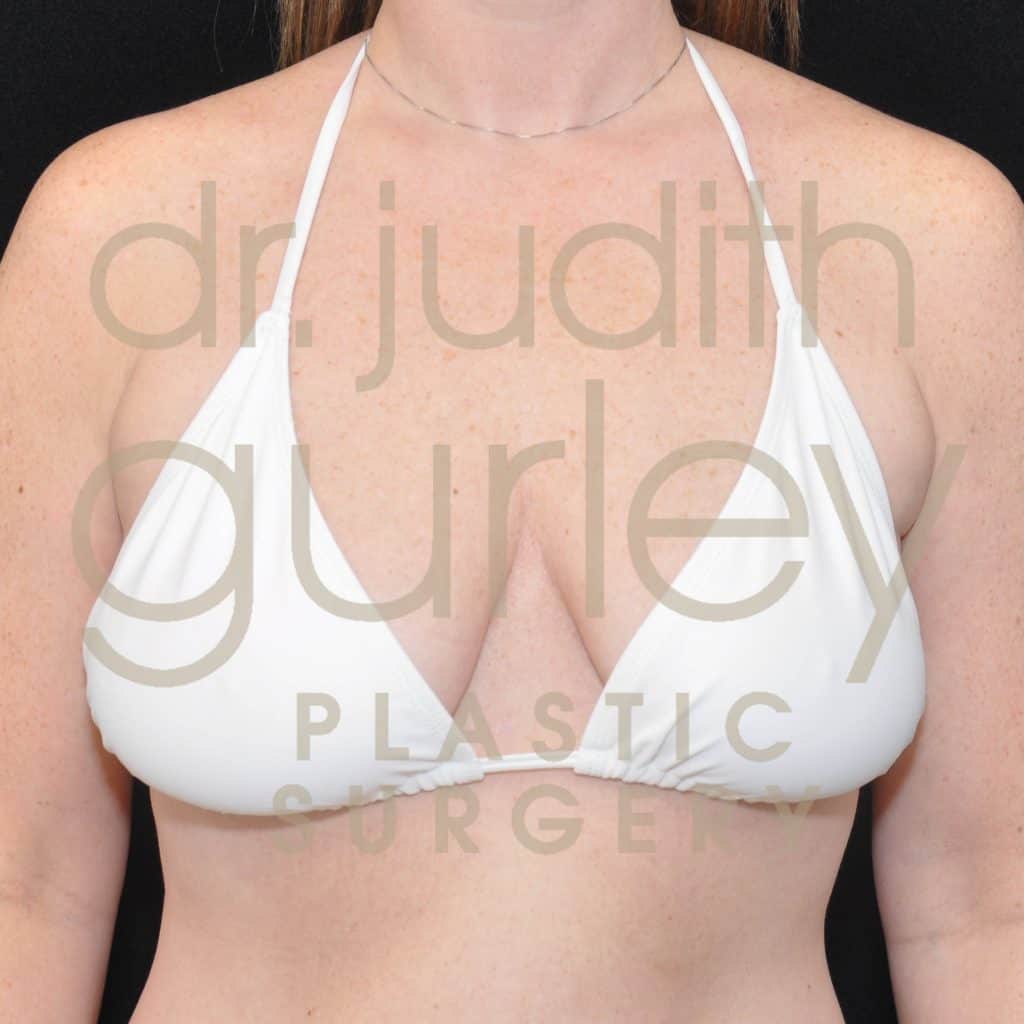 Breast Lift Before & After Patient #2764
