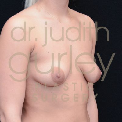 Tubular Breast Correction Before & After Results