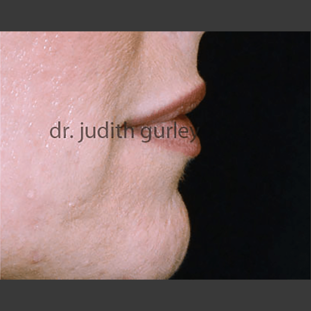 Facial Filler - Before and after results of a women's face