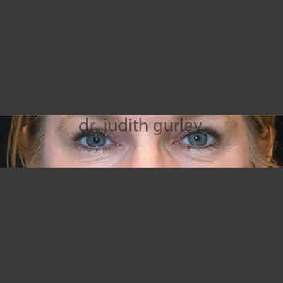 Eyelid Lift Plastic Surgery - Before and After