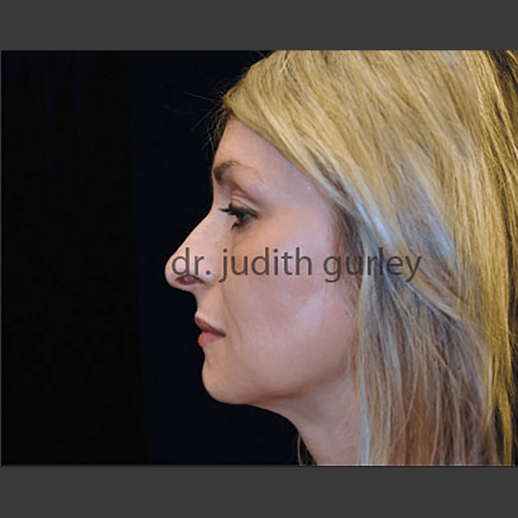 Botox - Before & After Side Face View Results
