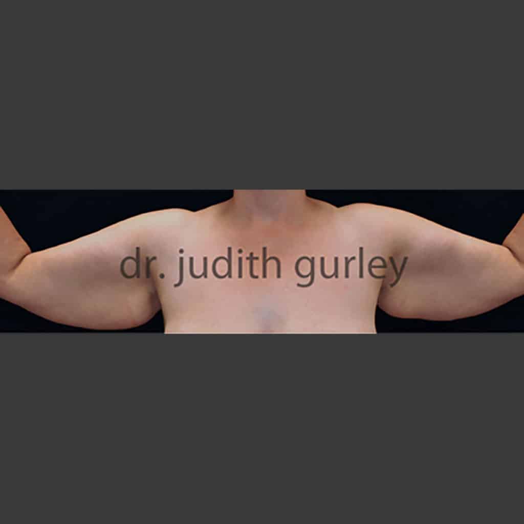 Body Arm Lift Plastic Surgery Before and After Results