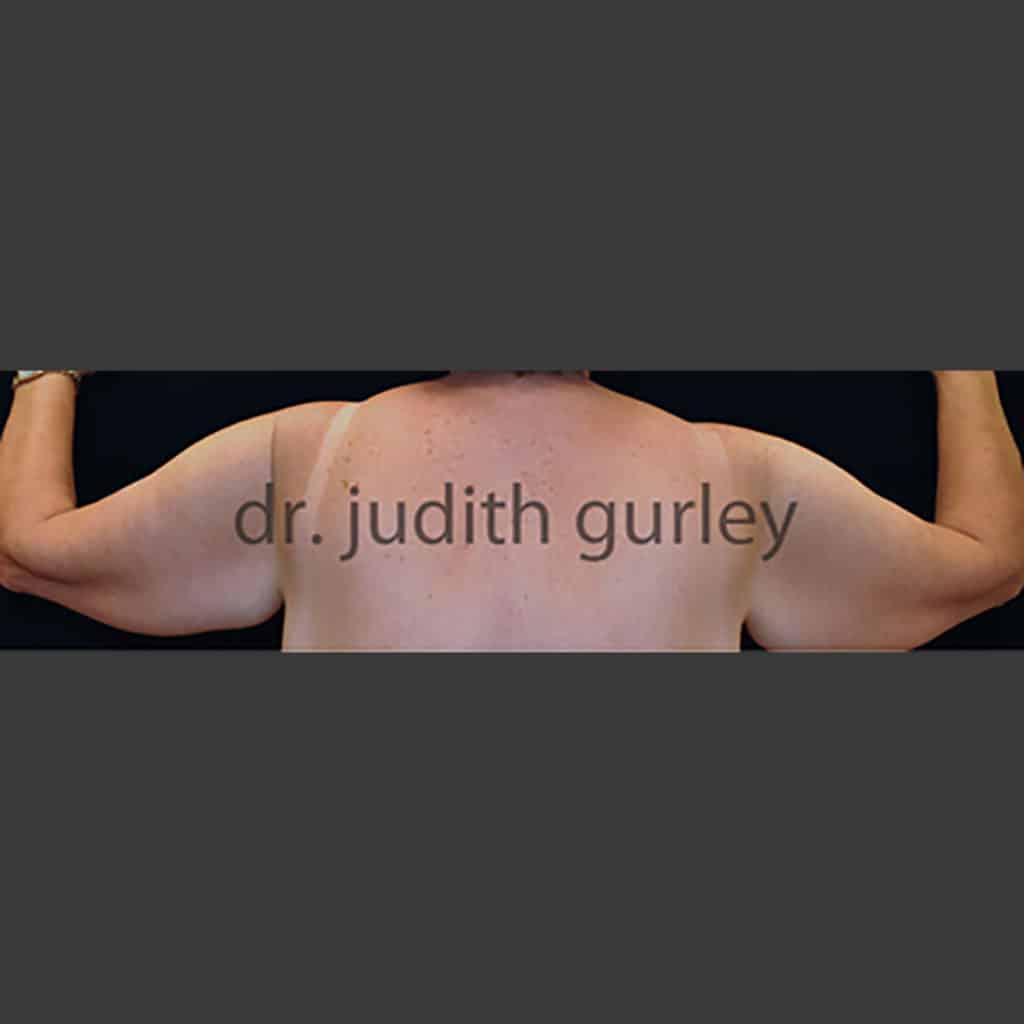 Body Arm Lift Plastic Surgery Before and After Results