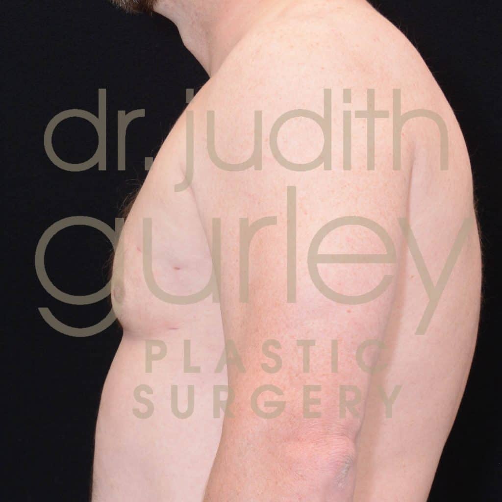 Gynecomastia Surgery Before and After Results