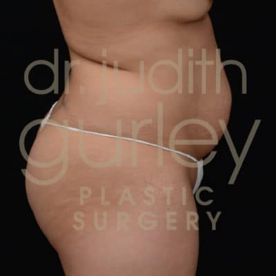 Actual Liposuction Before & After Plastic Surgery Results