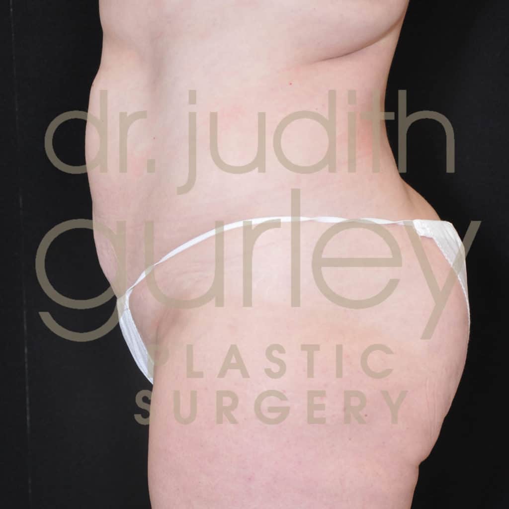 Liposuction Before & After Results