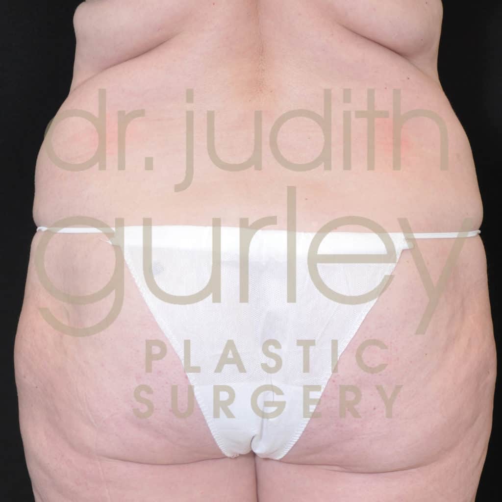 Liposuction Before & After Results