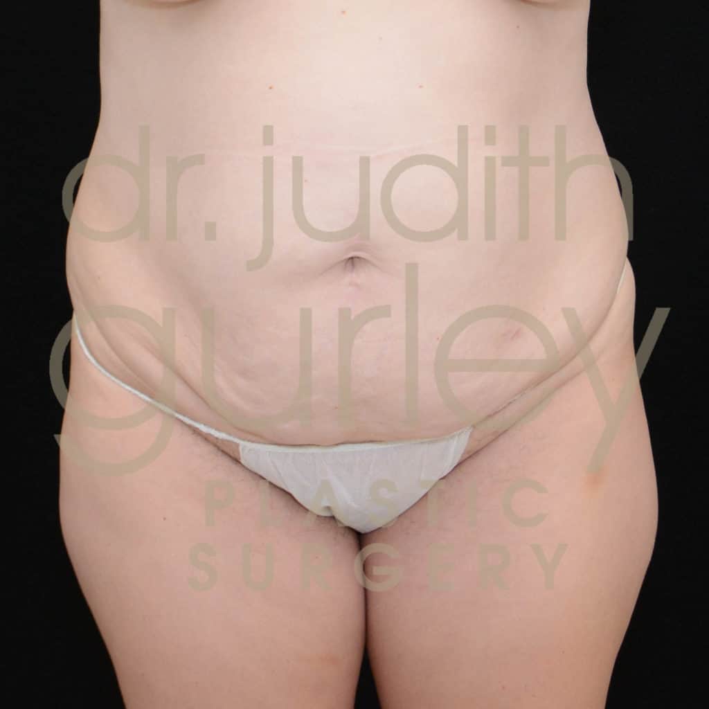 Tummy Tuck before and after results