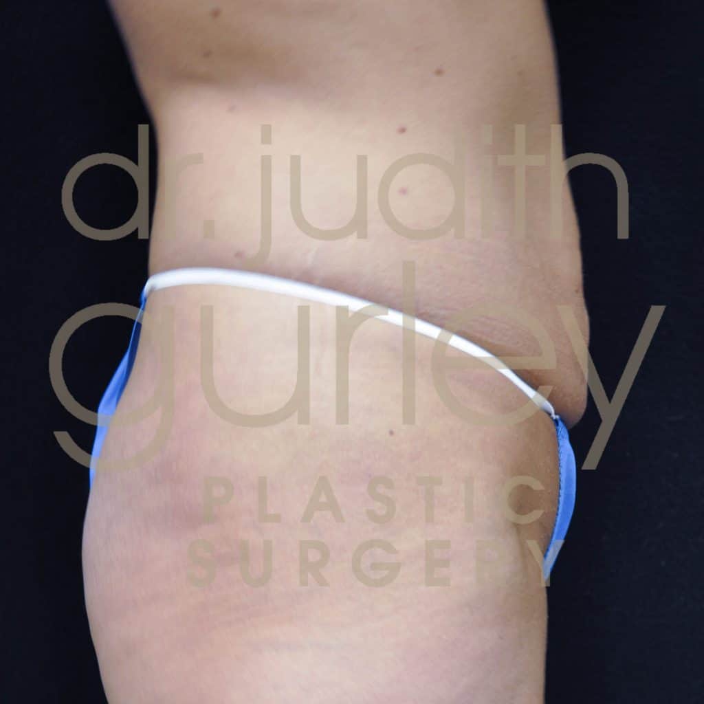 Tummy Tuck Plastic Surgery Before & After Results