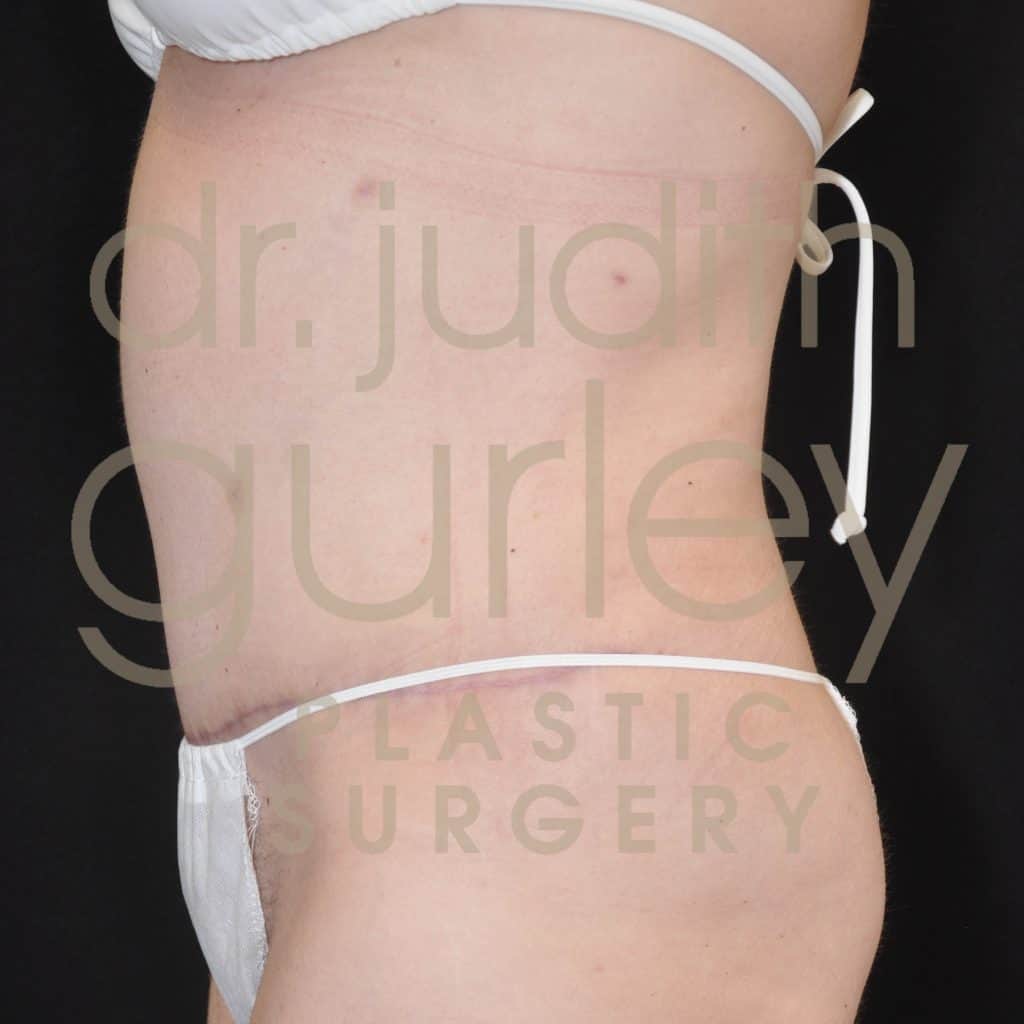 Tummy Tuck Surgery Before & After Results