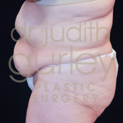Tummy Tuck before and after results