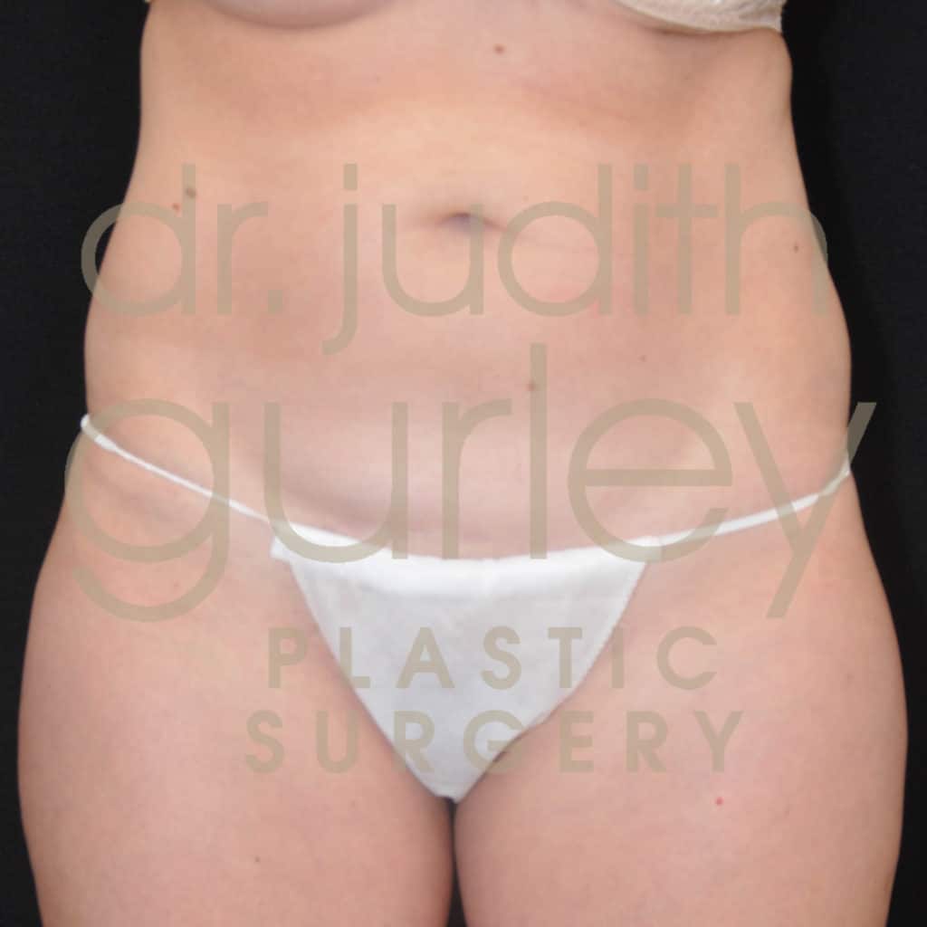 Mini Tummy Tuck Before And After Results