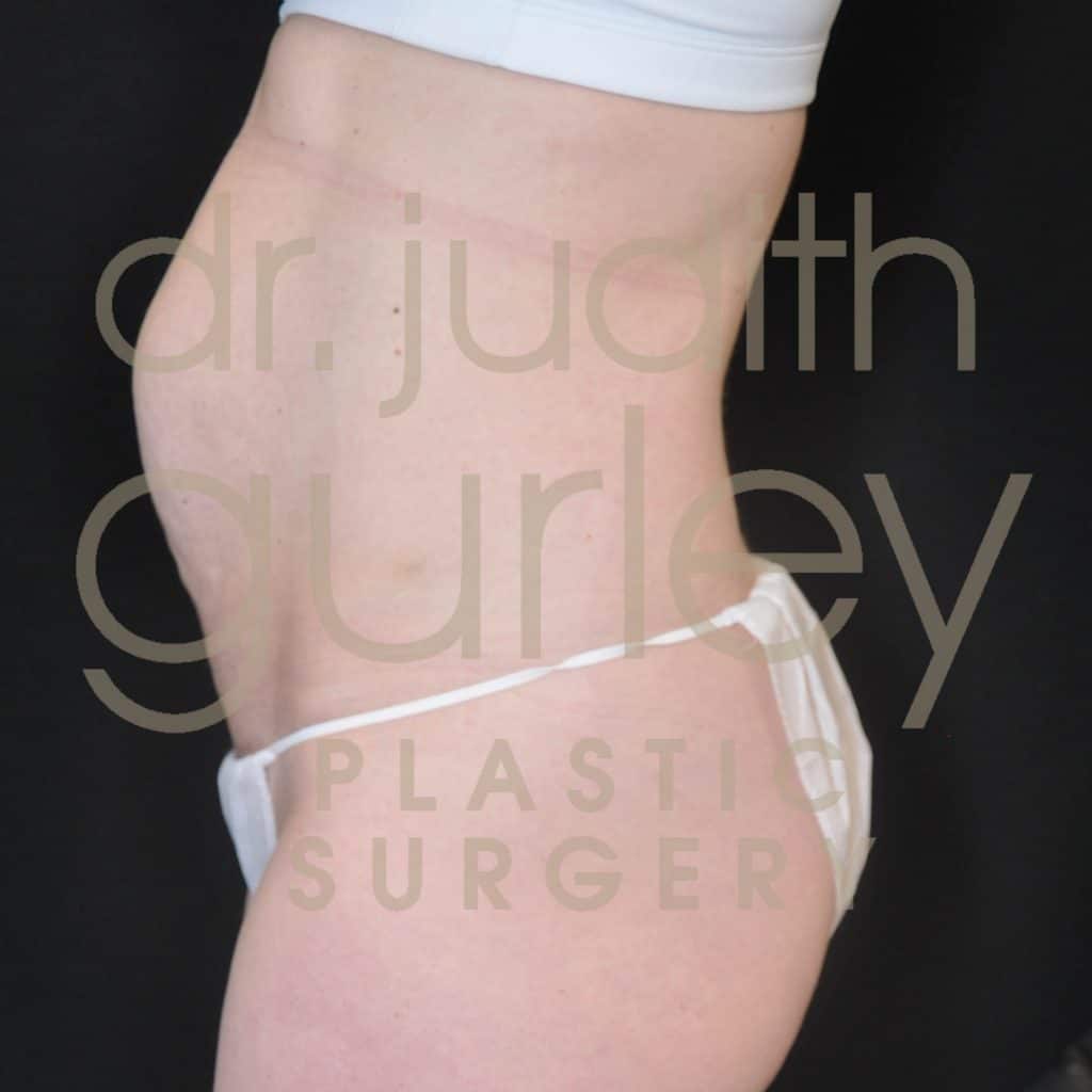Tummy Tuck Plastic Surgery Before & After Results