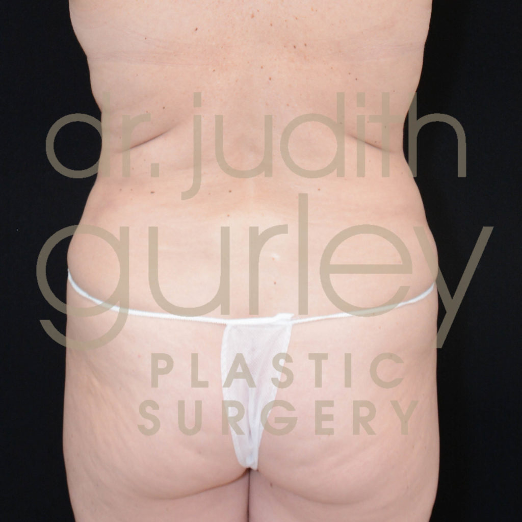 Liposuction Before & After Results Of A Women