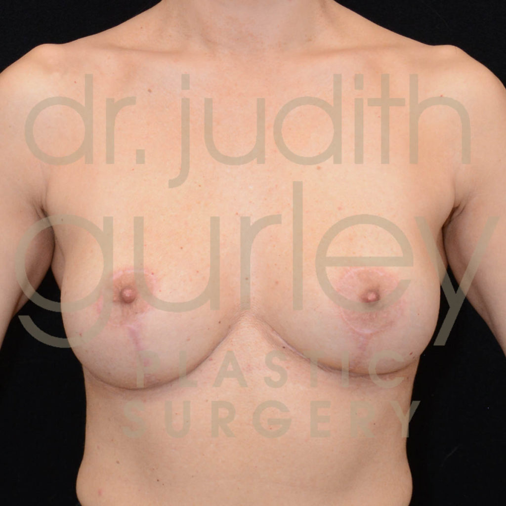 Breast Implant Removal with Lift Before & After Patient #5453