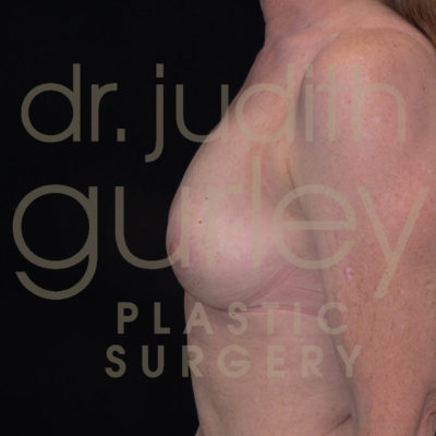 Breast Implant Removal with Lift Before & After Patient #5594