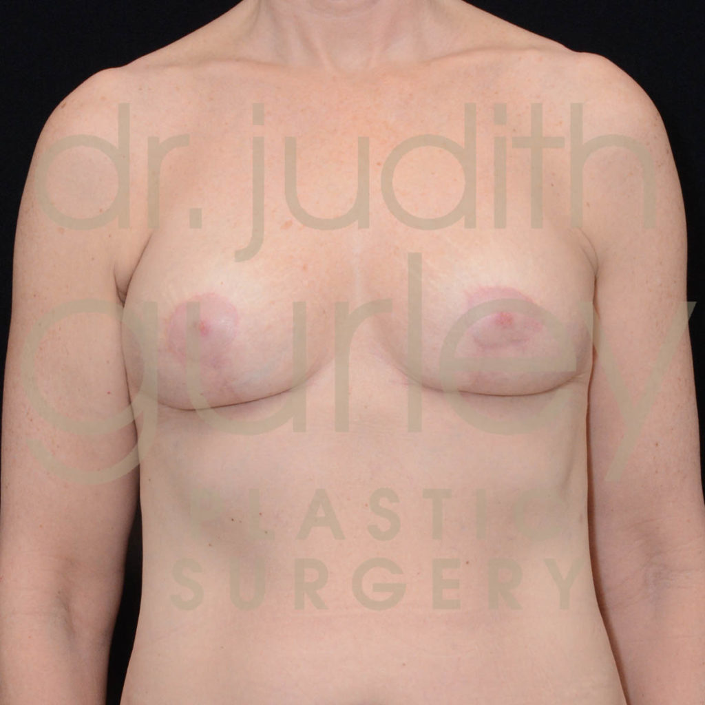 Breast Implant Removal with Lift Before & After Patient #5688