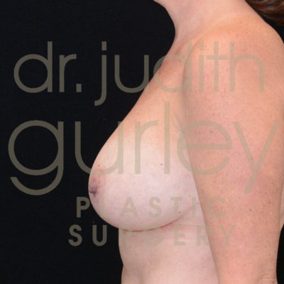 Breast Implant Removal with Lift Before & After Patient #5735