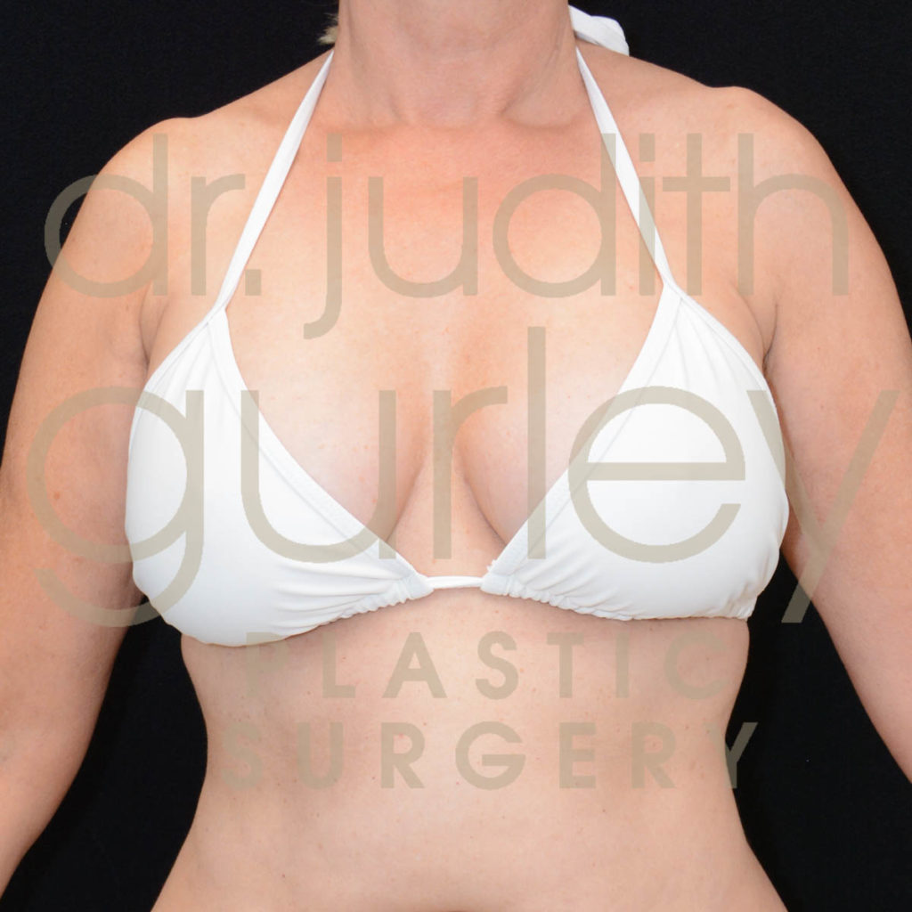 Breast Implant Removal with Lift Before & After Patient #5641